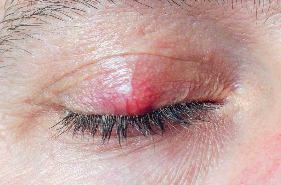 Operacje gradówki i jęczmienia