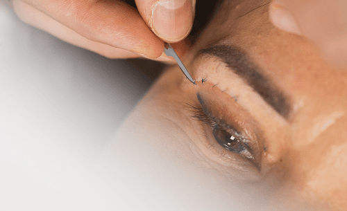 Plastyka powiek górnych