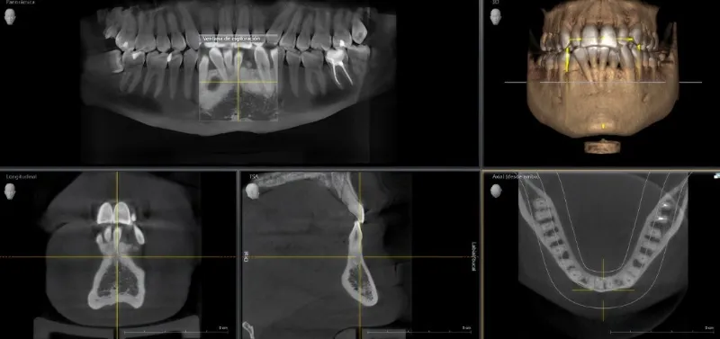 Tomografia komputerowa (CBCT)
